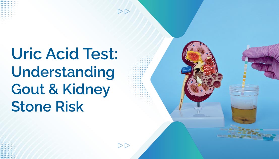 Uric Acid Test: Understanding Gout and Kidney Stone Risk