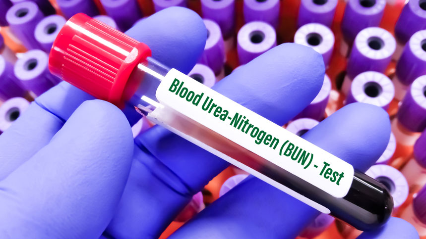 Blood Urea Nitrogen (BUN) Test: What Elevated Levels Indicate?