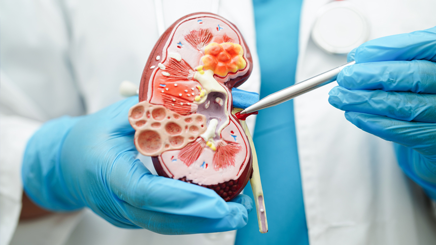 Proteinuria: An Early Sign of Kidney Damage