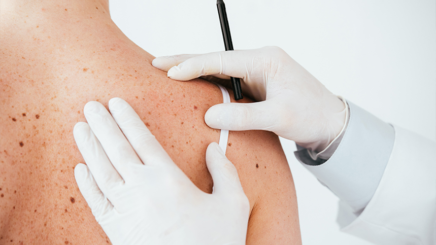 Melanoma Biomarkers: Early Detection and Monitoring