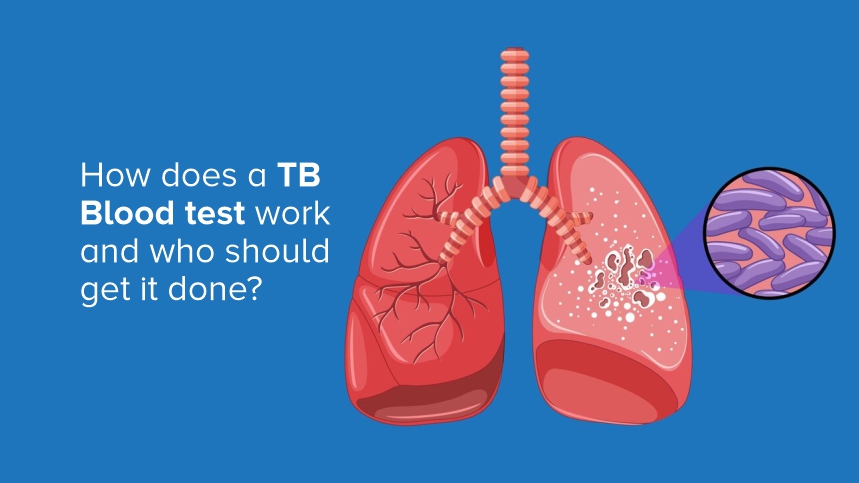 How a TB Blood Test Works and Who Should Get It Done?