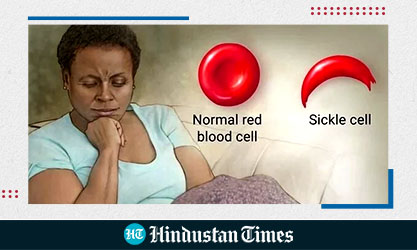 Sickle cell disease: Doctors reveal its causes, symptoms, preventive measures, treatment and therapies