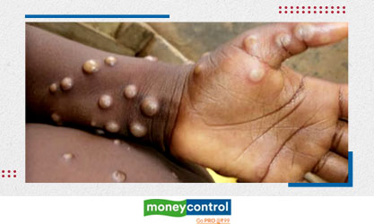 Monkeypox in India: No need to panic, say experts; call for stepped up diagnostics, preparation with smallpox vaccine