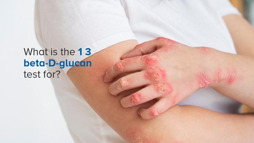 What Is the 1 3 Beta-D-Glucan Test and Why Is it Important?