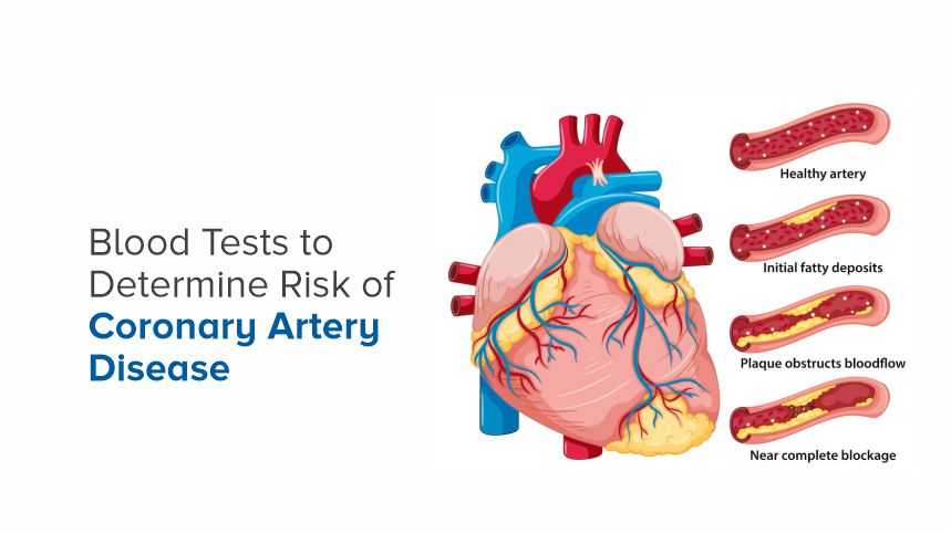 Hidden Threats Unveiled by Blood Tests for Coronary Artery Disease Risks