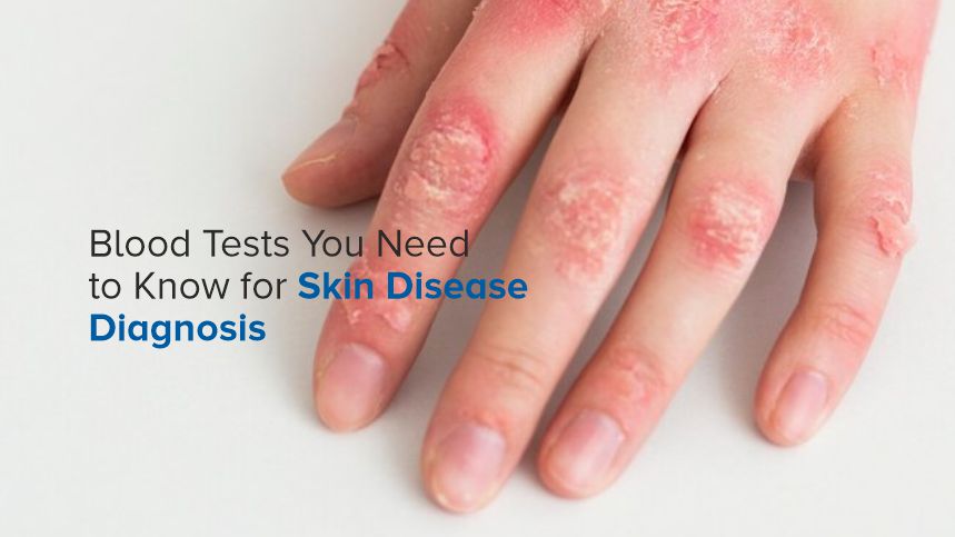 Essential Blood Tests for Skin Disease Diagnosis