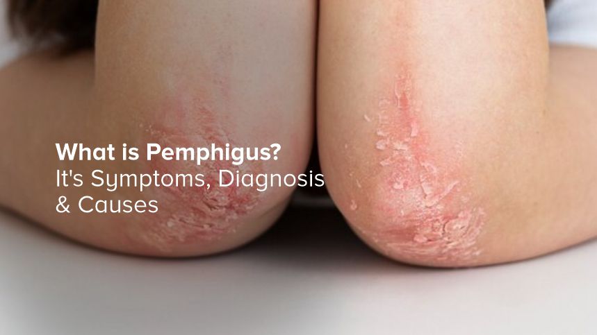 What Is Pemphigus? Symptoms, Diagnosis, and Causes