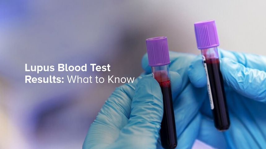 Lupus Blood Test Results: What to Know